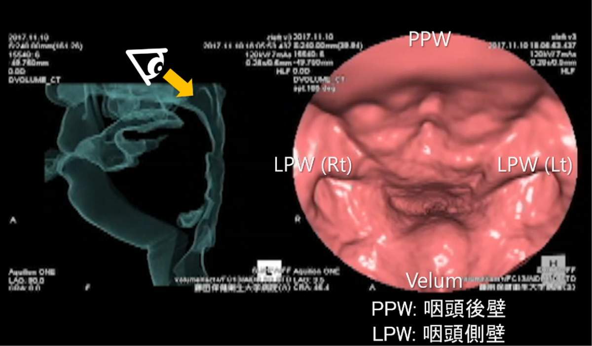 4DCTによる鼻咽腔閉鎖機能の画像