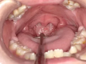 口蓋裂 術後の口腔内写真