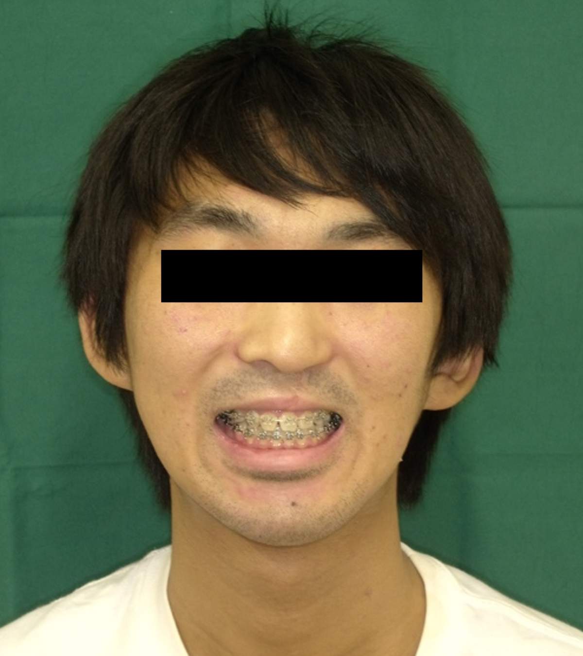 顎変形症 術後の顔貌写真
