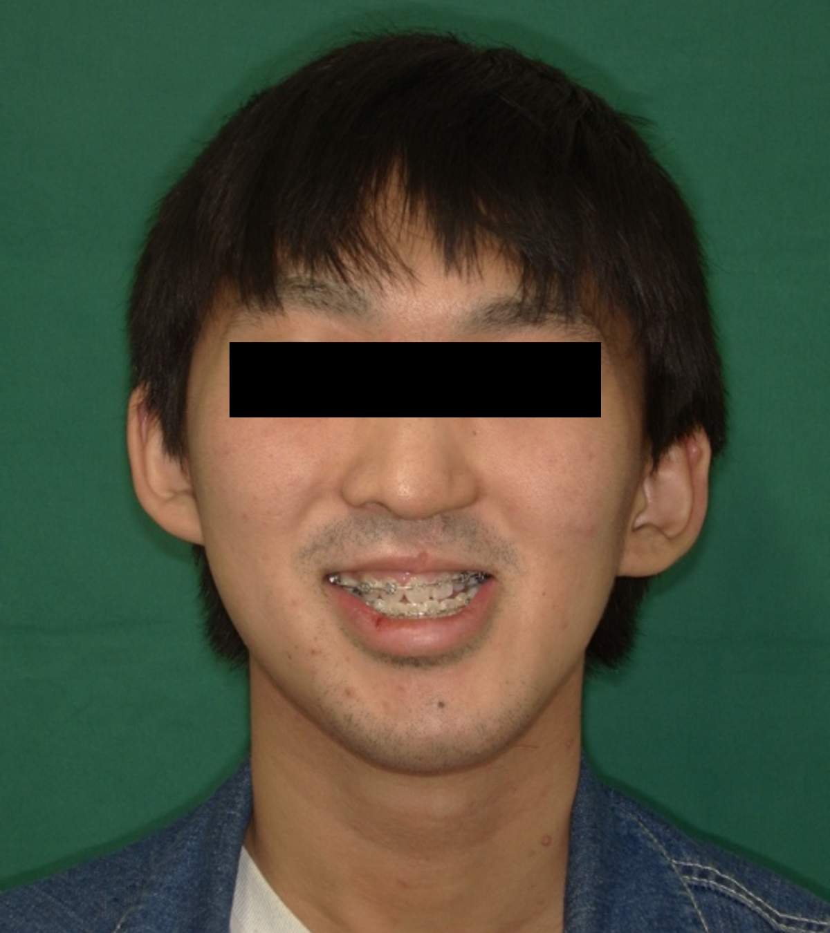 顎変形症 術前の顔貌写真