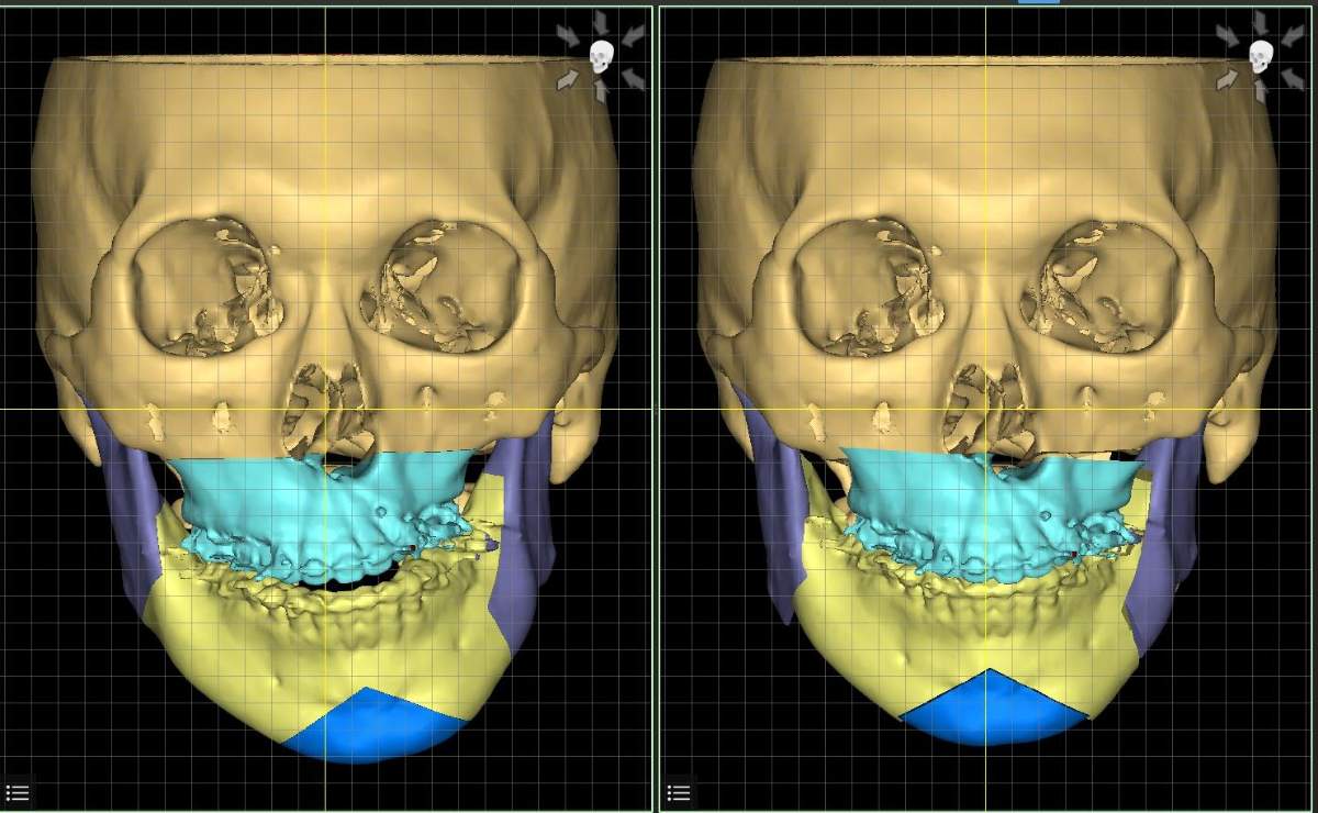 CT画像を用いた3Dシミュレーション（正面）