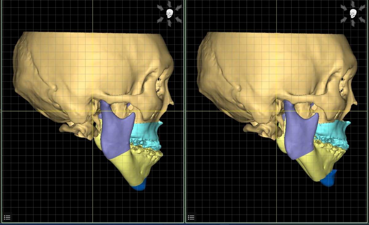 CT画像を用いた3Dシミュレーション（側面）